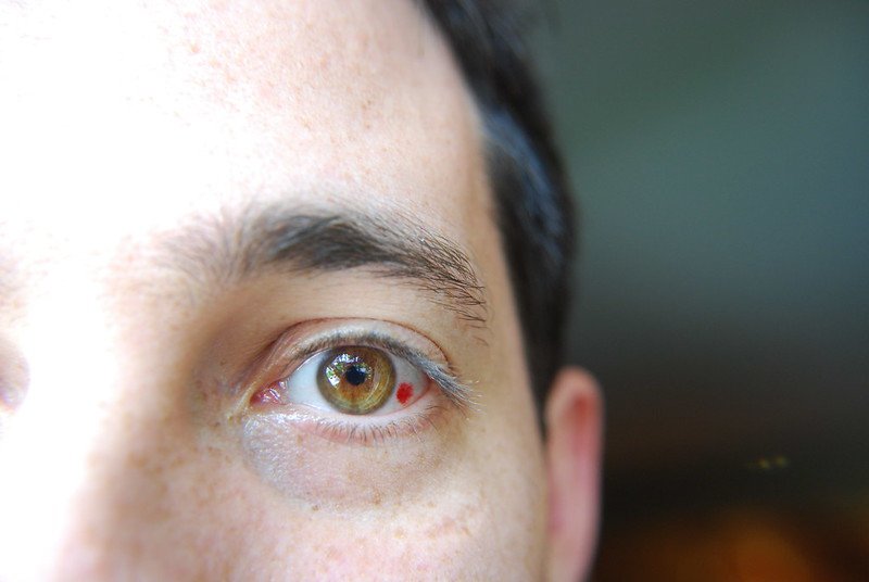 What a Popped Blood Vessel in Your Eye Reveals: Its Mystical Lesson